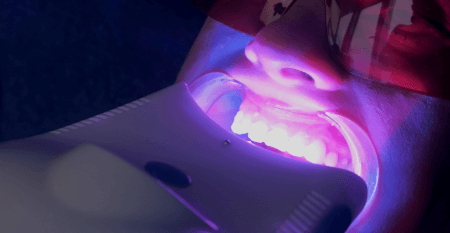 歯にLED照射する女性