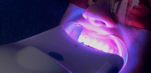 歯にLED照射する女性