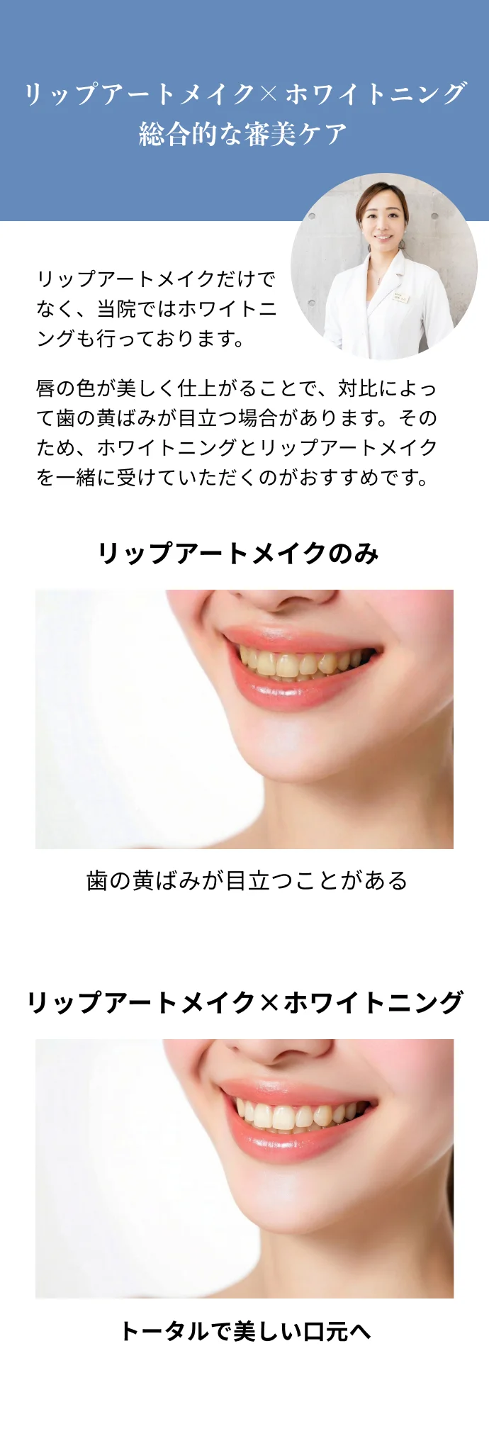 リップアート×ホワイトニングの総合的な審美ケア