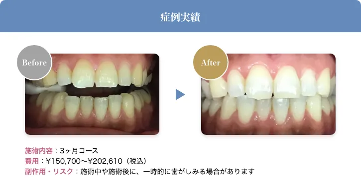 照射範囲が広いからより近づく理想の白さ