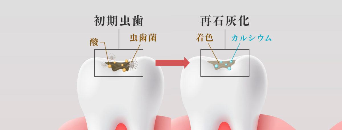 初期虫歯の状態を表した画像