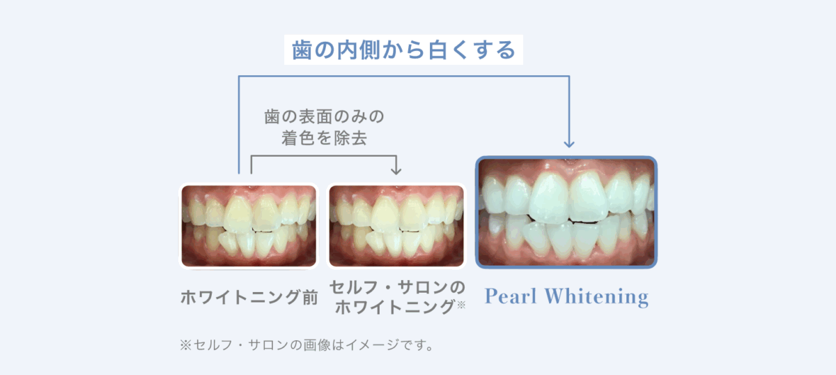 Pearl Whiteningの施術では歯の内側から白くします