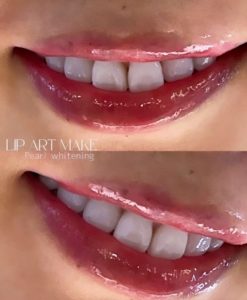 白い歯とリップアートメイク